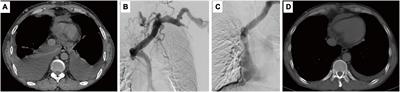 Case report: Severe dry cough associated with superior vena cava syndrome—Caused recurrent chylothorax